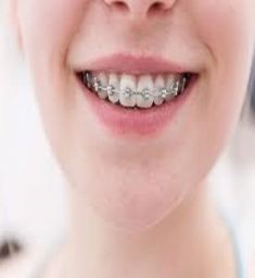 Braces Cost in Miami,FL