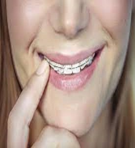 Braces Cost in Miami,FL