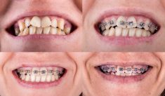 Dentist For Braces Near Me