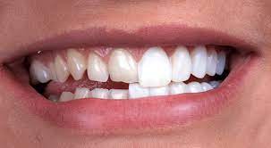Cosmetic Dentistry Manhattan, NYC