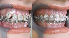 Can Braces Fix An Overbite?