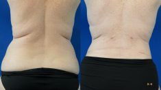 Brazilian Butt Lift (BBL) Surgery Near Me | Brazilian Butt Lift Procedure