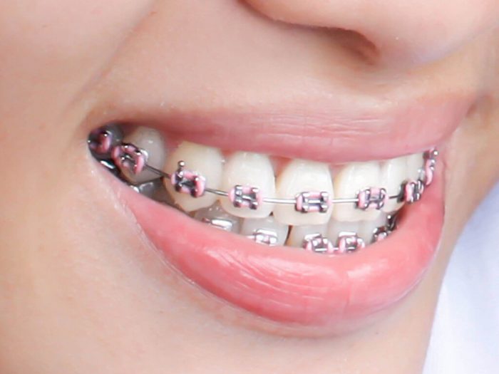 How braces are removed