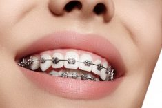 Why a Pediatric Orthodontist Near Me Matters? | IVANOV Orthodontic